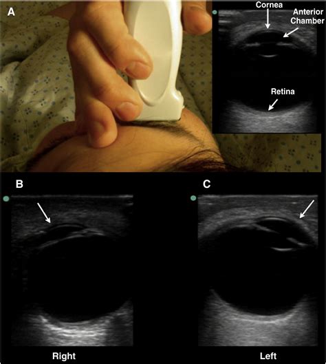 Ultrasound Assessment Of Extraocular Movements And Pupillary Light