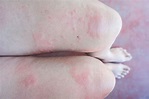 Can Stress Cause Hives? What to Know About Stress Rashes | Health.com