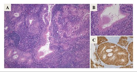 Figure 1 From Ciliated Squamous Cell Carcinoma Of The Tonsil Semantic Scholar