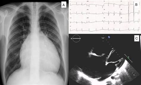 Electrocardiogram Ecg Chest X Ray And Transthoracic Echocardiography Images