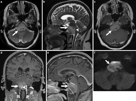 Mr Imaging 12 Months After Initial And Total Resection Of The Left