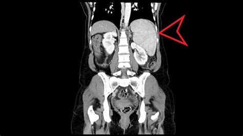 Abdomen Pelvis Ct Splenomegaly With Marked Pancytopenia Youtube