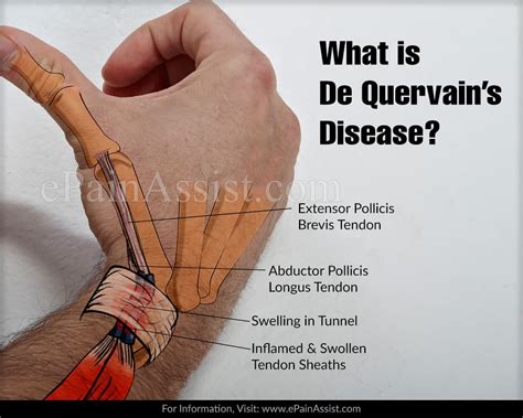 It occurs when the 2 tendons around the base of your thumb become swollen. What is De Quervain's Disease & How is it Treated?|Causes ...
