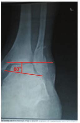 Left Ankle X Ray With Mortise View Two Months After The Injury Download Scientific Diagram