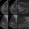 Tomosynthesis with synthetic mammography impr | EurekAlert!