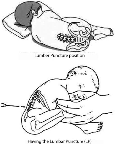 Lumbar Puncture Positions For A Child Download Scientific Diagram