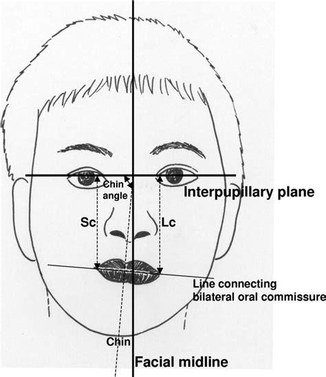Characteristics And Corrective Outcome Of Face Asymmetry By