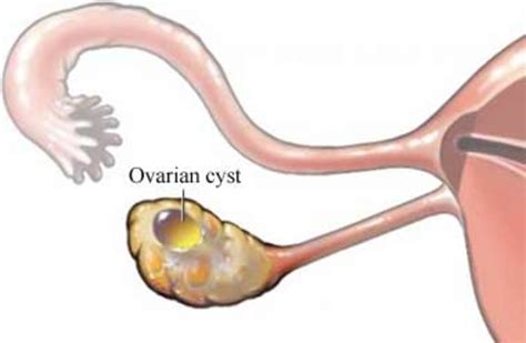 What You Can Expect If An Ovarian Cyst Bursts Hubpages