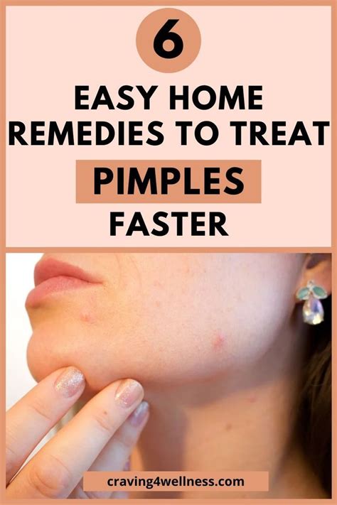 How To Treat Pimple Natural Ways In 2020 How To Treat Pimples