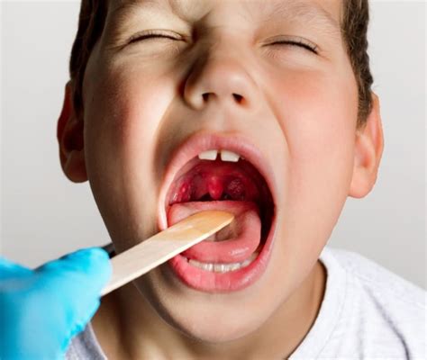 Streptococco Bambini Cos E Come Si Prende Il Mal Di Gola Cosa Fare E Rischi