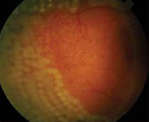 Extensive Panretinal Photocoagulation Laser Surgery Is Often Required