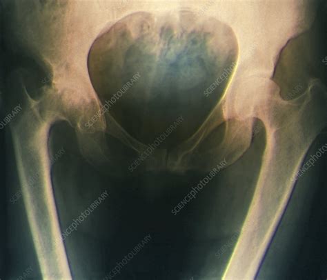 Osteoarthritis Of The Hip X Ray Stock Image C0095385 Science