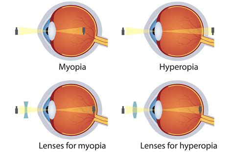 What’s The Difference Between Myopia And Hyperopia
