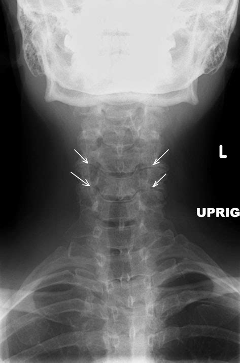 Cervical Spine X Ray Strategiesladeg