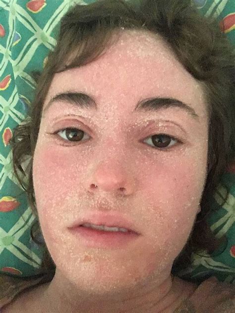 Woman Makes Incredible Eczema Recovery After Ditching Steroid Creams