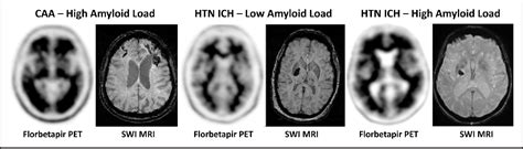 Figure 4 From Advanced Neuroimaging To Unravel Mechanisms Of Cerebral