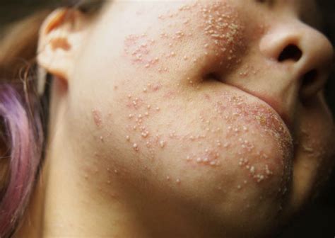 Allergic Reaction Rash Pictures Causes Treatment Symptoms 2021