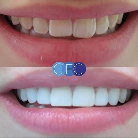 Antes y después diseño de sonrisa carillas dentales de CFC Carlos