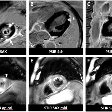 Cardiac Magnetic Resonance Imaging Of A Patient With Irm Following A