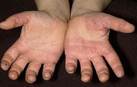 Hand Fungus Pictures Symptoms Treatment And Causes 2018 Updated