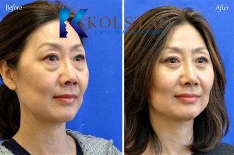 Asian Facial Plastic Surgery Dr Kolstad See Hundreds Of Results