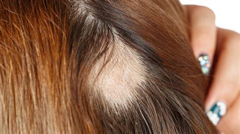 Las Mujeres También Sufren La Alopecia Estos Son Los Mejores