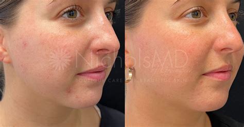Nicholsmd Of Greenwich Microneedling With Prp Treatment Nicholsmd Of Greenwich