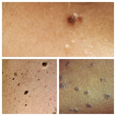 Black Spots On Skin Face And Body Causes And Treatment 2022