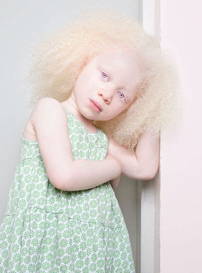 Alltag Mit Albinismus Portr Ts Zeigen Das Leben Der Betroffenen