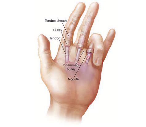 Trigger Finger Endoscopic Treatment In Montreal By Hand Surgeon