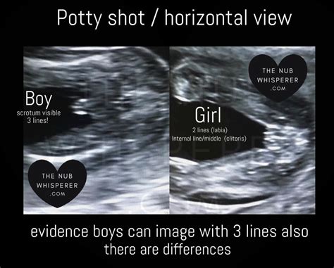 Normal 21 Week Baby Ultrasound Artofit