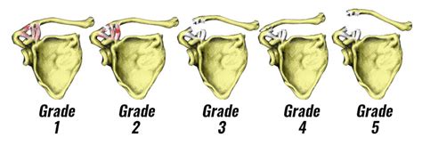 Ac Joint Separation Symptoms Causes And Treatment Explained