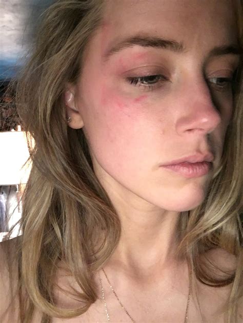 Johnny Depp Says Amber Heard Painted Fake Bruises On Her Face