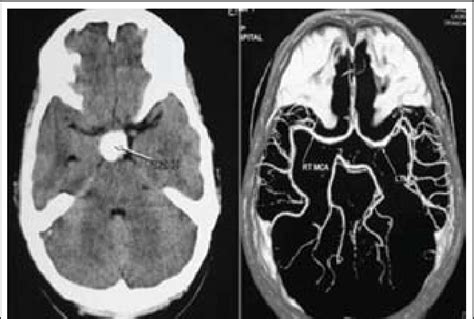 A Ct Brain Showing A Well Defined Hyperdense Mass Lesion Located