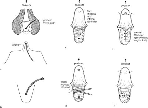 Figure From The Endorectal Advancement Flap Procedure Semantic Scholar