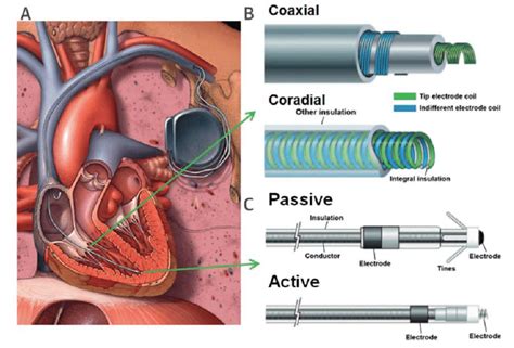 An Illustration Of A Typical Pacemaker System With Pacemaker Leads Download Scientific Diagram