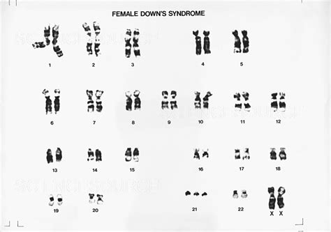Photograph Female Karyotype Showing Down S Syndro Science Source Images
