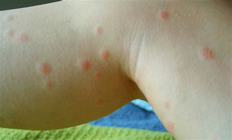 Top 15 Proven Home Remedies For Chigger Bites Natural Relief From Tiny