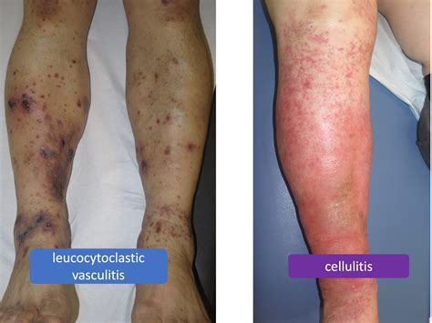 Vasculitis Types