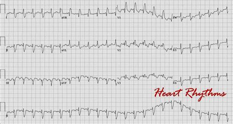 Typical Atrial Flutter And Ecg Ukrainesmash