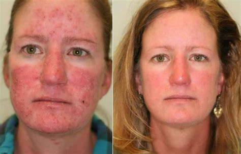 Rosacea Treatment Downtown La Ipl Resurfx Laser And Photodynamic