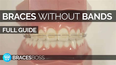 Braces Without Bands Full Pro Guide 2023 Bracesboss