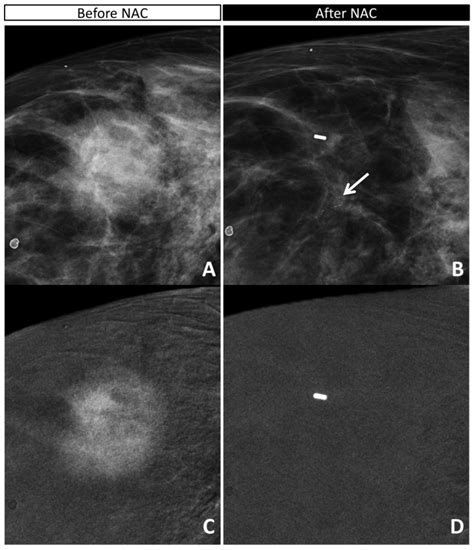 Diagnostics Free Full Text Accuracy And Reproducibility Of Contrast Enhanced Mammography In