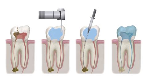 Root Canal Treatment Rockville MD Bethesda MD