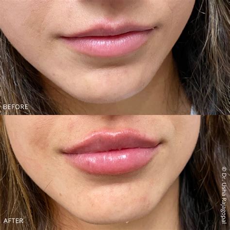 Bay Area Lip Augmentation Plump Organic And Healthy Lips Usha