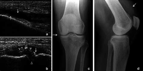 A D A 52 Year Old Man With Gouty Arthritis Of The Left Knee A