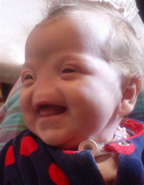 This Baby Girl Born Without A Nose Is One In A Million Her Story Will