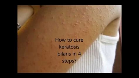 How To Cure Keratosis Pilaris In Easy Steps Youtube