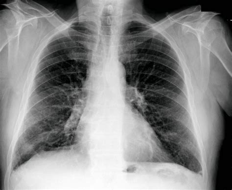 Casesblog Medical And Health Blog Clinical Case Asbestosis In A