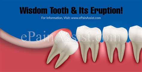 Wisdom Tooth And Its Eruption Symptoms And Treatments
